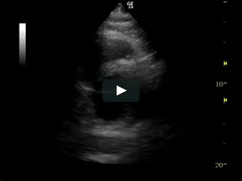 septal wall hypokinesis treatment.